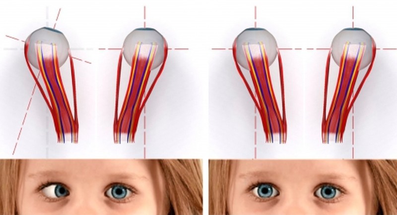 Операция на глаза косоглазие у ребенка. Исправление косоглазия. Операция на косоглазие у детей. Операция по коррекции косоглазия у детей.